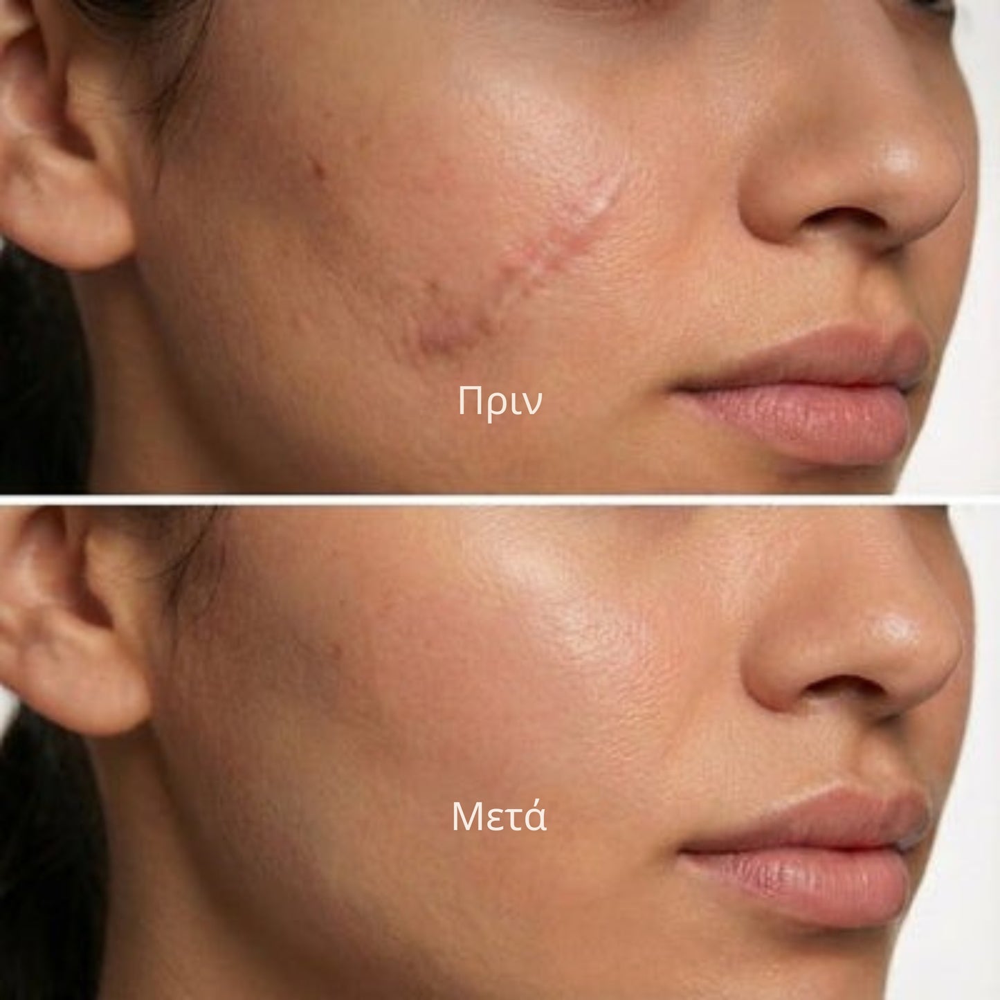 Derva™ Scar Solutions Στικ Σιλικόνης
