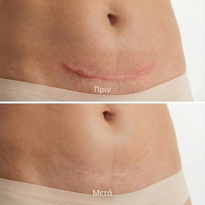 Derva™ Scar Solutions Στικ Σιλικόνης