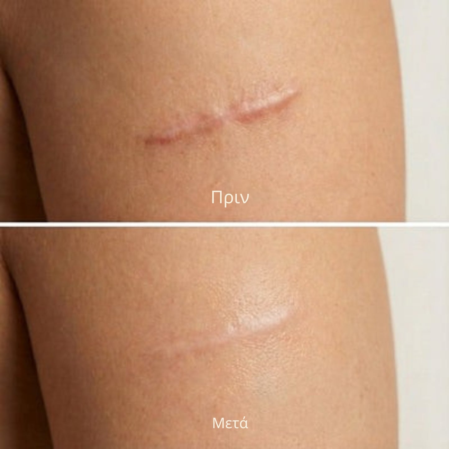 Derva™ Scar Solutions Στικ Σιλικόνης